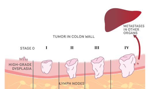 colon cancer stage 0